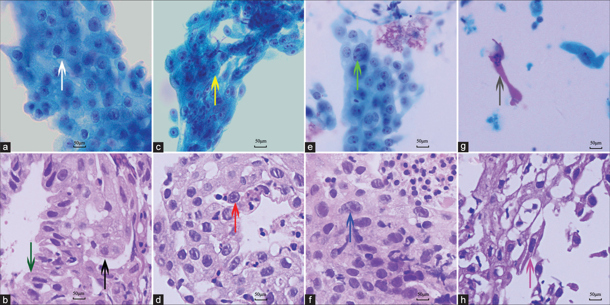 Cytomorphological and corresponding histological characteristics of squamous atypia in endobronchial tuberculosis. Papanicolaou stain, ×400 (a, c, e, and g). Hematoxylin and eosin stain, ×400 (b, d, f, and h). (a and b) Squamous metaplasia (white arrow in 2a and black arrow in 2b) derived from ciliated columnar epithelial cells (green arrow in 2b). (c) Brushing cytology showing prominent nucleoli (yellow arrow). (d) Mature squamous metaplasia exhibiting reactive cytologic atypia with prominent nucleoli (red arrow). (e and f) Cytopathology and histologic biopsy showing squamous cells with enlarged nucleus mimicking the tumor cells (Cyan arrow in 2e and blue arrow in 2f). (g and h) Scattered squamous cells exhibiting definite keratinization and twisted cytoplasm (gray arrow in 2g and pink arrow in 2h). Figures 2b, 2d, 2e, and 2h are the paired biopsies of 2a, 2c, 2f, and 2g, respectively.