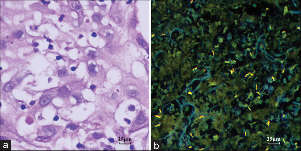 Dispersed necrosis within atypical squamous epithelium enriched with Mycobacterium tuberculosis (MTb). (a) Necrosis permeating into the space of the reactive squamous epithelium. Hematoxylin and eosin staining, ×400 (b) MTb in the necrosis. Auramine-rhodamine stain, ×400 figures 3a and b are for the same patient.