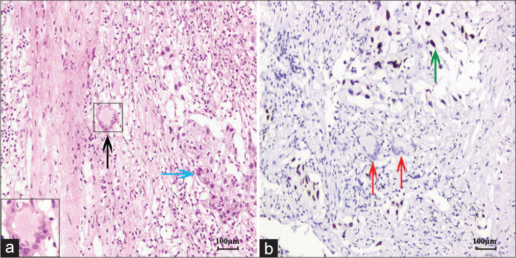 Histology and immunohistochemistry of endobronchial tuberculosis concurrent with non-small cell carcinoma. (a) Langhans giant cell (black arrow) and nests of carcinoma cells (blue arrow) (inset: At twice size). Hematoxylin and eosin staining, ×200 (b) thyroid transcription factor 1 (TTF-1) positive adenocarcinoma cells (green arrow) arranged in solid pattern and around the Langhans giant cells (red arrows) (Envision, ×200).