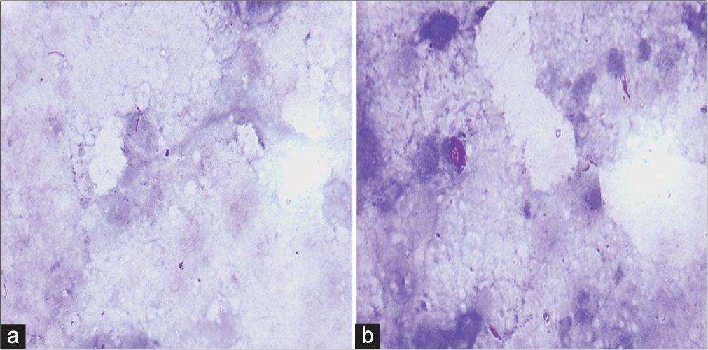 Acid--fast bacilli on Ziehl-Neelsen stain. (a and b) Acid-fast beaded slender rods lying singly, (a, x1000) as well as in clumps, and (b, x1000) in an extracellular location (x1000).