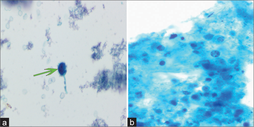 Illustration of undetermined LBC features. Papanicolaou stain, ×400. (a) Cases with inadequate sampling displaying single atypical cells in the observation field (green arrow). (b) Absence of definite atypical cells in the presence of necrotic background. (LBC: Liquid-based cytology.)