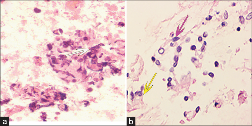 Examples of undefined cell block diagnoses. Hematoxylin and eosin (stain, ×400). (a) Distorted cells with technical artifacts, hindering correct morphological identification despite the presence of a necrotic background (white arrow). (b) Degenerated ciliated columnar epithelial cells (purple arrow) raising suspicion, although cells with distinct cilia (yellow arrow) are occasionally found in the vicinity.