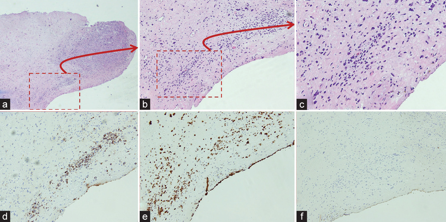 Left vaginal biopsy; (a: H&E, ×4; b: H&E, ×10; c: H&E, Zoomed) demonstrated sheets of pleomorphic spindle cells with variable cellularity. (d-f: immunohistochemistry, ×10) focal immunoreactivity for CAM5. 2, aberrant p53 expression, and non-immunoreactivity for desmin.