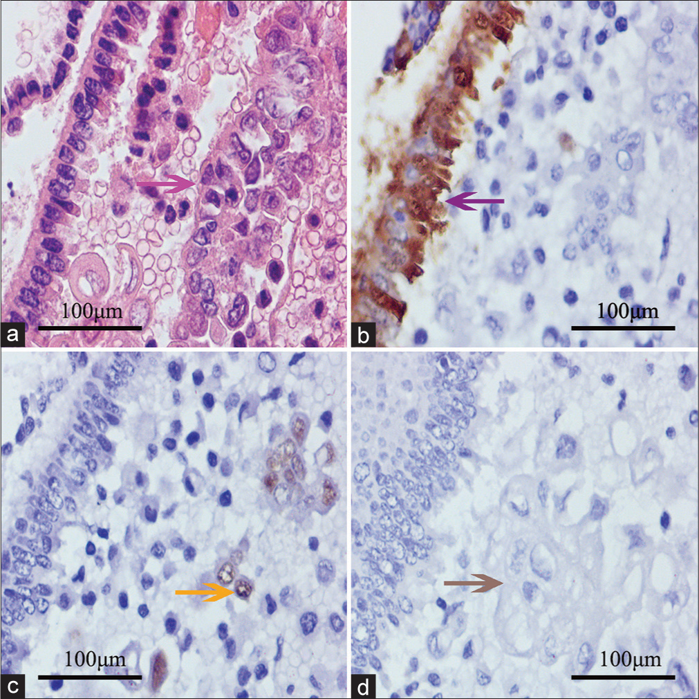 Routine stain and immunocytochemistry of positive abdominopelvic washing. (a) Mesothelial cells in chain pattern (left) and endometrioid cancer cells (right, pink arrow); (b ) Hector Battifora Mesothelial-1 (HBME-1) demonstrating positive to mesothelial cells (purple arrow) and negative to endometrioid cancer cells (right); (c) SOX17 positive endometrioid cancer cells (yellow arrow); and (d) tumor cells negative to paired-box gene-2 (gray arrow). The images were collected from the same block of a patient.