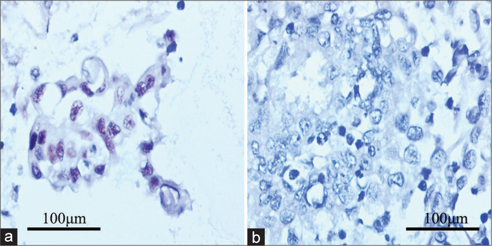 P53 and mismatch repair immunocytochemistry for the positive abdominopelvic washing from cases with relevant molecular classification. (a) Tumor Protein p53 (P53) overexpression presenting mutational status; and (b) MutS Homolog 6 (MSH6) negativity in accordance with primary lesion.