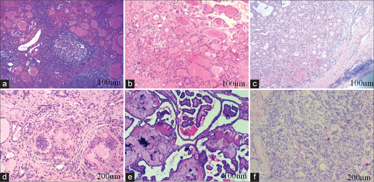 Cytopathology in patients with thyroid nodules by ultrasound-guided fine-needle aspiration cytology. (a) Hashimoto’s thyroiditis. Lymphadenia, formation of lymphoid follicles, and acidophilic degeneration of follicular epithelium among thyroid follicles were observed (100 µm). (b) Atypical fo llicular adenoma. Rich neoplastic cells, inconspicuous follicular structure in some areas, and mild heterogenic cells were observed (100 µm). (c) Onco1cytoma. The eosinophilic infiltration of thyroid cells, consistent nuclear size, obscure heteromorphism, and complete fibrous capsule around thyroid follicles were observed, and no capsule and vascular invasion were observed (100 µm). (d) Subacute thyroiditis. Destroyed thyroid follicles and overflowed colloids, the infiltration of fibroblast hyperplasia, lymphocytes, plasma cells, neutrophils, and eosinophils, and the reaction of histiocytes and multinucleated giant cells were observed (200 µm). (e) Papillary thyroid carcinoma. Papillary structure and gravel-like calcification could be found (100 µm). (f) Medullary thyroid carcinoma. The cells were arranged in follicular, nested, and trabecular ways. The cytoplasm was bicolorophilic, the nucleus was round or oval, and the chromatin was coarse (200 µm). (3a-f: Hematoxylin and eosin)