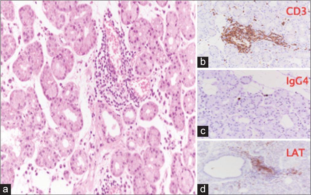 Case 1 biopsy of the right orbital tissues, performed in March 2019. (a) Lobules of lacrimal gland with >two foci of periductal and perivascular lymphocytic infiltration and minor interstitial infiltrate, consisting of CD3+ LAT+ T lymphocytes (b & d), without a significant increase in immunoglobulin G4-positive plasma cells (c). (Hematoxylin and Eosin (H&E) stain, ×20 magnification). (CD3: Cluster of Differentiation 3, IGg4: Immunoglobulin G4, LAT: Linker for activation of T cells.)