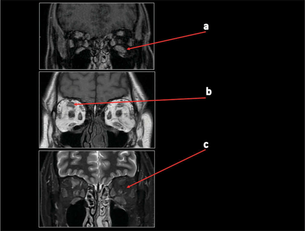 Case 1 magnetic resonance imaging with contrast scan in November 2021. (a) A red arrow is pointing to volumetric reduction of tumefactive alterations in the extrinsic muscles with modest contrast enhancement of the examined muscle structures. (b) A red arrow is pointing to a slight decrease in the size of the solid tissue that was previously inseparable from the complex of the upper right rectus. (c) A red arrow is showing that both optic nerves and intra-orbital adipose tissue exhibit normal signal, morphology, and course.