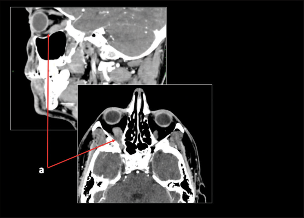 Case 2 computed tomography scan in February 2019. A red arrow is pointing to a volumetric increase of the inferior rectus muscle of the right orbit (measuring 12 mm) compared to the left side (9 mm).