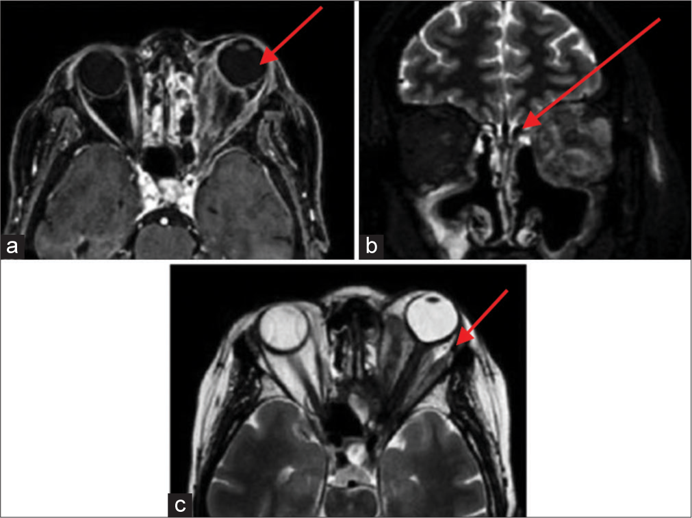 Case 3 magnetic resonance imaging with contrast scan in June 2018. (a) A red arrow is pointing to a marked condition of left exophthalmos, accompanied by a significant volumetric increase in the extrinsic ocular musculature, the optic nerve in all assessable segments with liquid distension of the peri-optic sheath. There is pronounced hyperintensity in signal within the retrobulbar adipose tissue, along with soft-tissue edema. (b) A red arrow is pointing to evidence of inflammatory tissue involving the ethmoidal cells on the left side, the sphenoidal sinus, and the frontal sinuses, particularly on the left. (c) A red arrow is pointing to a notable volumetric increase visible following intravenous gadolinium administration in all previously mentioned structures consistent with the clinical inquiry, suggesting an ocular manifestation of Wegener’s granulomatosis.