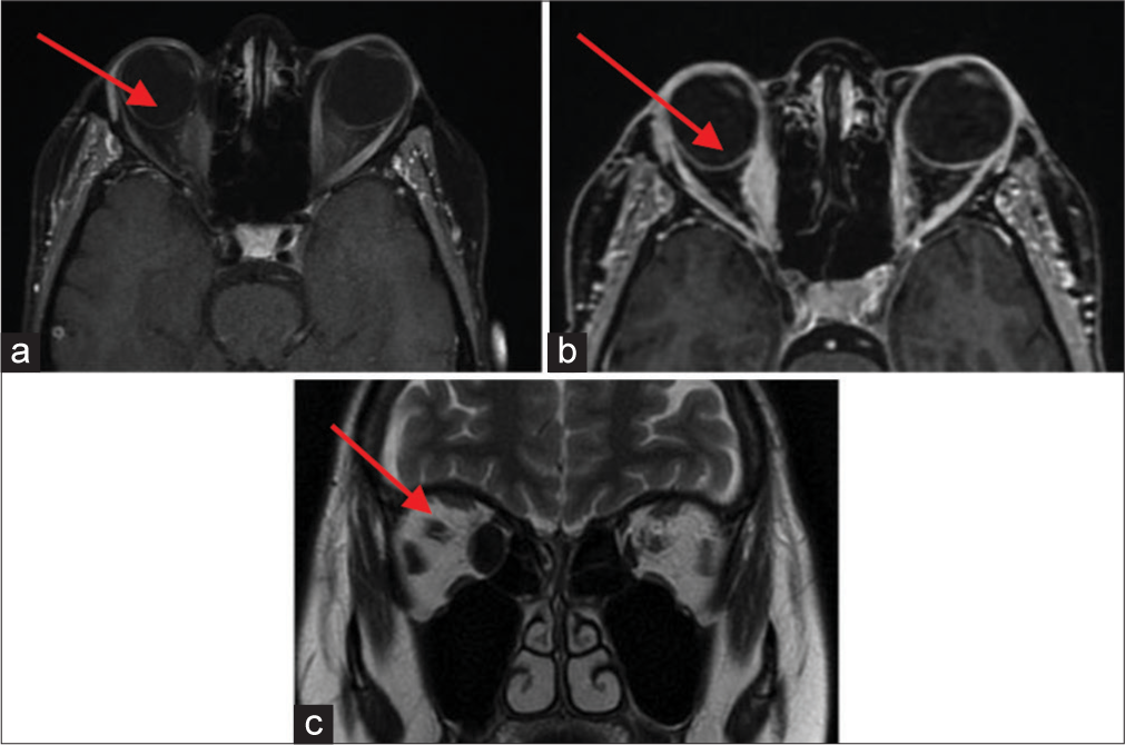 Case 4 magnetic resonance imaging with contrast scan in August 2020. (a) A red arrow is pointing to a fusiform thickening of the right medial rectus muscle (10 mm). (b) A red arrow is pointing to a slight thickening in the right lateral rectus muscle (4 mm compared to 2.3 mm at the left side) and the right superior oblique muscle (4.2 mm on the right compared to 2.3 mm at the left side). (c) A red arrow is pointing to evidence of a slightly sinuous course in the intraorbital segment of the optic nerve at the left side. Both optic nerves exhibit a regular signal.