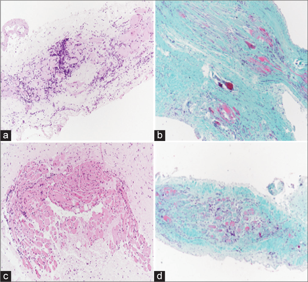 Case 4 biopsy of the lateral rectus muscle of the left eye, performed in May 2021. (a-d) are illustrating different parts of soft tissues and bundles of striated muscle that show degenerative-regressive phenomena of muscle fibrocells, collagen fibrotic dissociation, and significant T-cell lymphocytic infiltration. (Hematoxylin and eosin (H/E) stained, ×20 magnification).