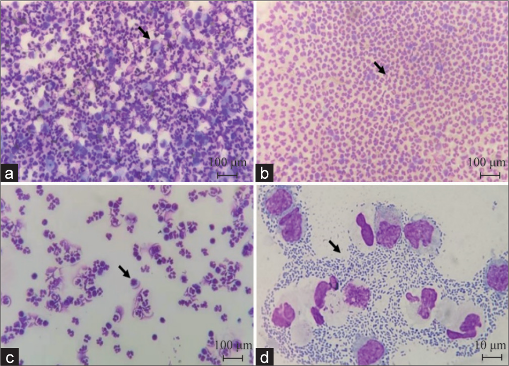 Cerebrospinal fluid cytology (May-Grunwald-Glemsa staining). (a) Neutrophil inflammatory response (black arrow indicates monocytes-macrophages)(×100); (b) neutrophil inflammatory response (black arrow indicates neutrophils)(×100); (c) inflammatory response of neutrophils and lymphocytes (black arrow indicates activated lymphocytes)(×100); and (d) a large number of bacterial cells in the intercellular space (indicated by arrow), the cells are in pairs and arranged in clusters, under the light microscope (×10).