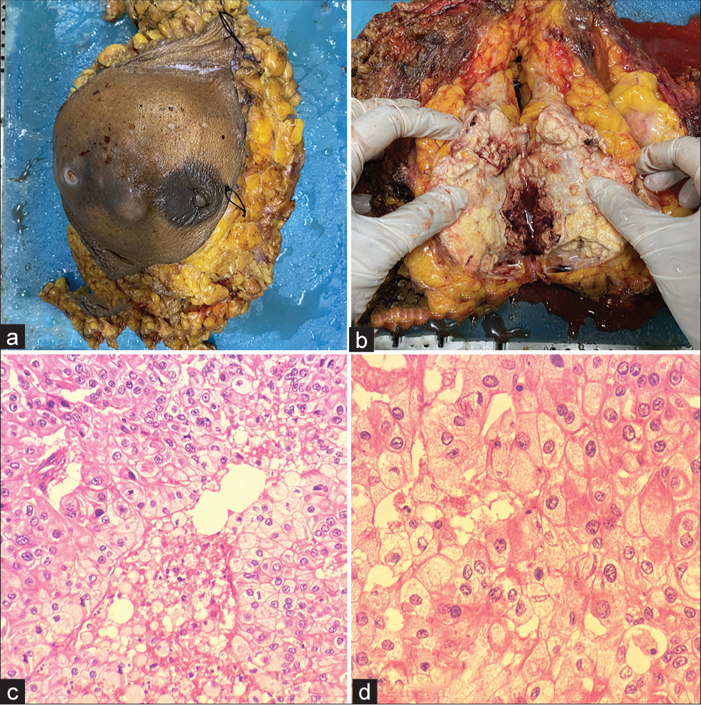 Gross and histopathology of the lesion: (a) Gross image of the modified radical mastectomy specimen, (b) Cut section of the tumor, (c) Histological section of the tumor (hematoxylin & eosin [H & E], ×200), and (d) Section showing the cells with apocrine differentiation (H & E, ×400).