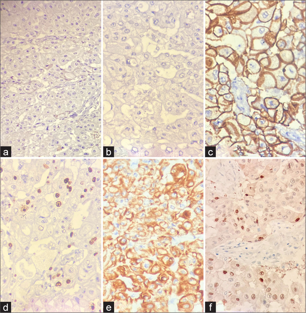 Immunohistochemistry of the tumor: (a) Estrogen receptor (ER) is negative in tumor cells (ER and Diaminobenzidine [DAB], ×200), (b) Progesterone receptor (PR) is negative in tumor cells (PR and DAB, ×200), (c) Human epidermal growth factor receptor 2 (HER2)/neu shows diffuse, strong membranous positivity (Grade 3+) (HER2 and DAB, ×200), (d) Ki-67 (Proliferation marker) is positive in 46% of cells (Ki-67 and DAB, ×200), (e) Cytokeratin (CK5/6/8/18): Strong cytoplasmic to membranous positivity in >50% of the cells (CK5/6/8/18 and DAB, ×200), and (f) Androgen receptor is positive in the nuclei of cells with apocrine morphology (androgen receptor and DAB, ×200).