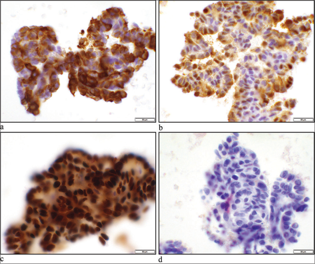 (a) Cytokeratin-7 showing cytoplasmic stain (×40 objectives). (b) S100 demonstrates nuclear and cytoplasmic staining of neoplastic cells (×40 objectives). (c) SOX10 shows nuclear staining of the tumor cells (×40 objectives). (d) Thyroid transcription factor-1 shows negative nuclear stain (×40 objectives).