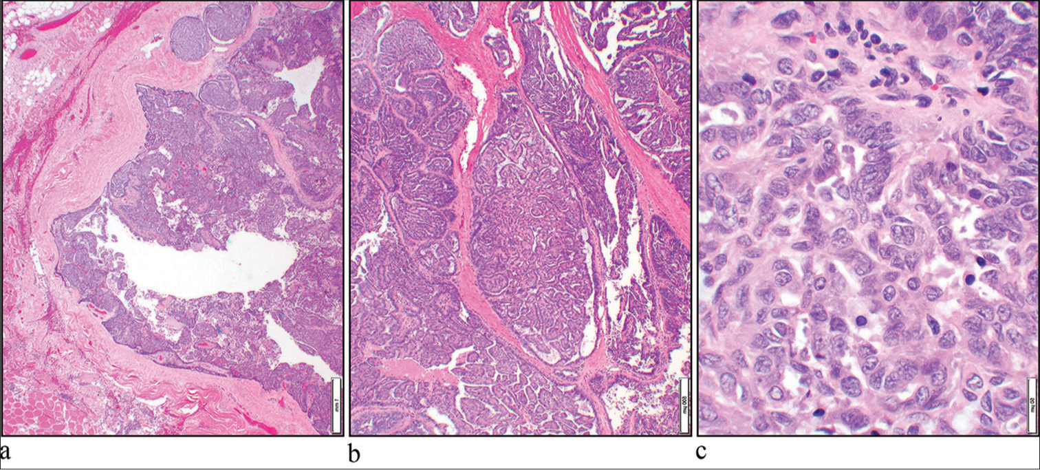 (a) Hematoxylin and eosin (H&E) stain shows an infiltrative neoplasm (×4 objective). (b) The tumor had a prominent papillary architecture (H&E, ×10 objective). (c) The nuclei show open chromatin (H&E, ×40 objective).