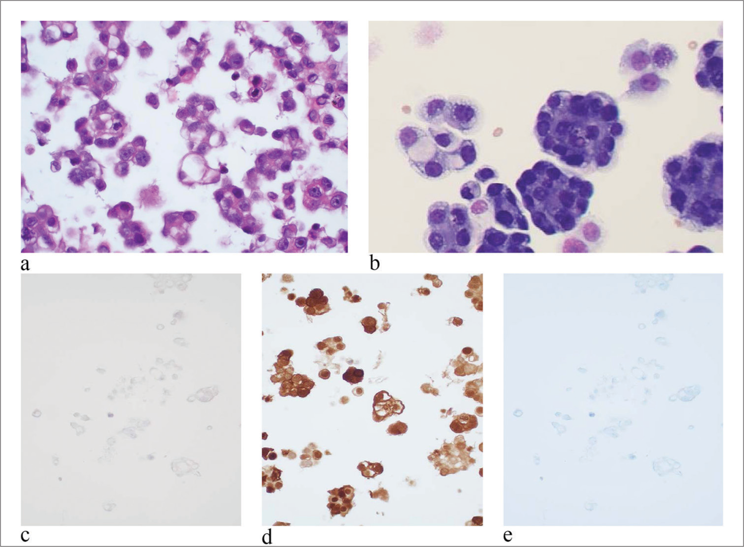 Epithelioid signet ring cell mesothelioma. (a) Tumor cells were arranged as numerous three-dimensional clusters. However, no true papillary fragments with fibrovascular cores were identified. (hematoxylin and eosin stain, 20×). (b) Tumor cells have an epithelial appearance and distinct cell borders. The nuclei are eccentrically located with irregular nuclear membranes. Single or several prominent nucleoli were seen. The cytoplasm of the tumor cells is vacuolated and has two-tone appearance. The N/C ratio of tumo r cells is high (papanicolaou stain, 40×). (c) IHC stain of CD68 is negative. 20× magnification. (d) IHC stain of calretinin is diffusely positive for mesothelial cells (20×). (e) IHC stain of claudin-4 is negative (20×), (N/C: nuclear/cytoplasmic, IHC: immunohistochemical.)