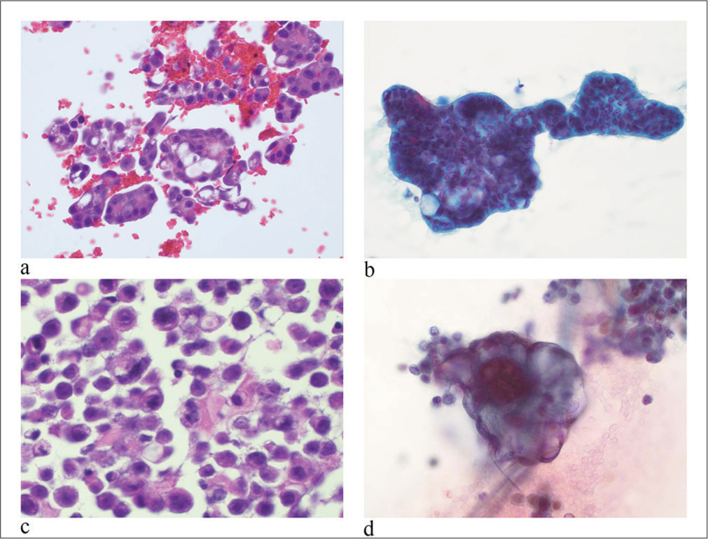 Malignant pleural effusion of metastatic carcinomas. (a) Tumor cells are arranged pre dominantly in three-dimensional clusters. Tumor cells have large hyperchromatic nuclei, irregular nuclear membranes, fine to coarse chromatin, and single or multiple prominent nucleoli. (hematoxylin and eosin stain, 20×) (b) A metastatic pancreatic adenocarcinoma contains cytoplasmic mucinous material. (papanicolaou stain, 20×). (c) A metastatic breast carcinoma contains discohesive individual tumor cells. Tumor cells have eccentrically located nuclei and cytoplasmic mucin, giving the signet ring cell morphology. (hematoxylin and eosin stain at 20×). (d) A metastatic carcinoma of the gynecologic primary. Tumor cells contain psammoma bodies. (papanicolaou stain at 40×).