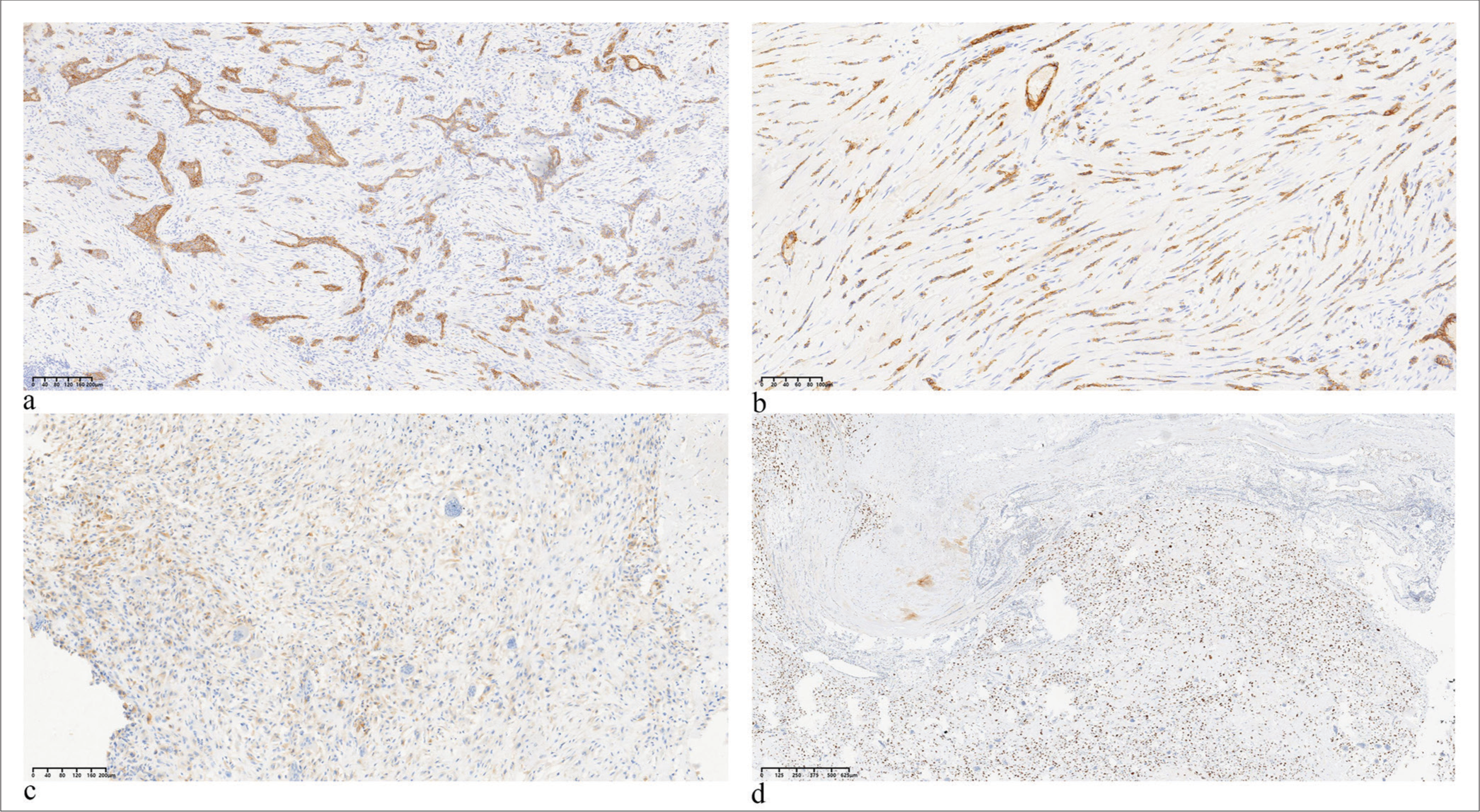 Four positive expression markers in metaplastic carcinoma. (a) E-cadherin (×40), (b) cluster of differentiation CD24 (×40), (c) epidermal growth factor receptor (×40), and (d) P53 (×100). (EGFR: Epidermal growth factor receptor)