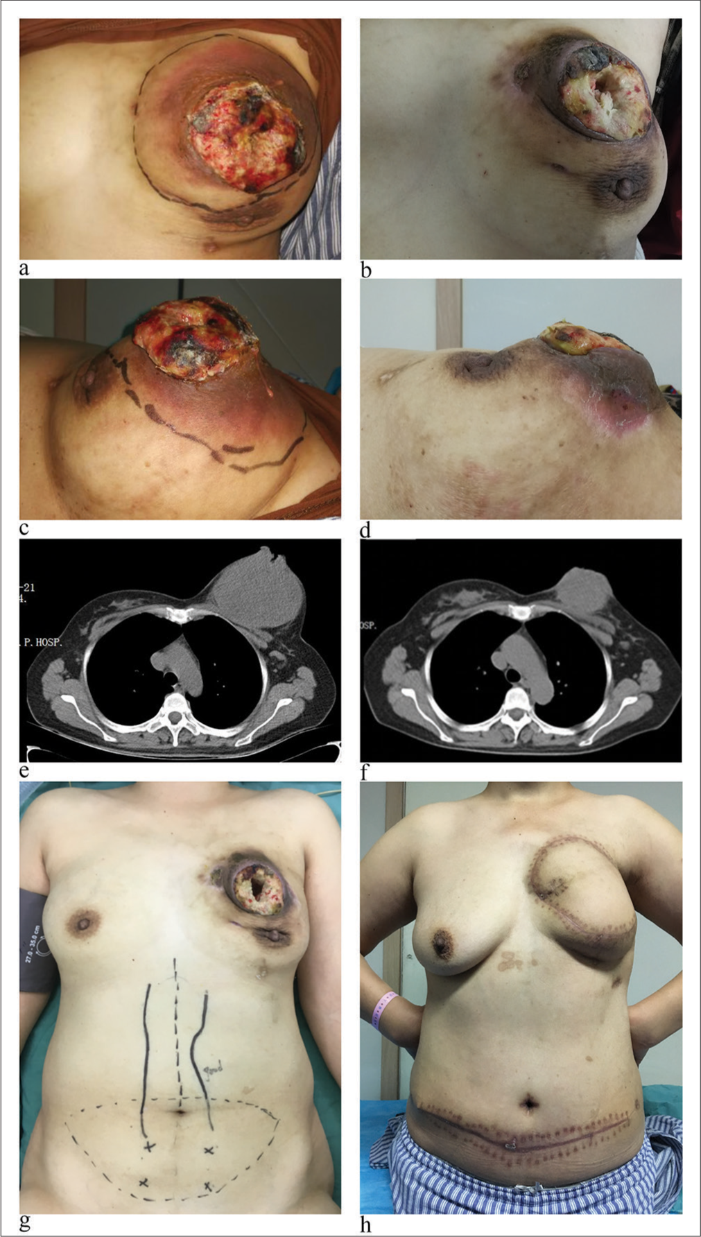 The comparison of effects before and after anti-angiogenesis treatment: (a and b) Before anti-angiogenesis treatment. (c and d) Effects after 4 cycles of anti-angiogenesis treatment. (e and f) Computed tomography scan images (g and h) comparison before and after surgical treatment.