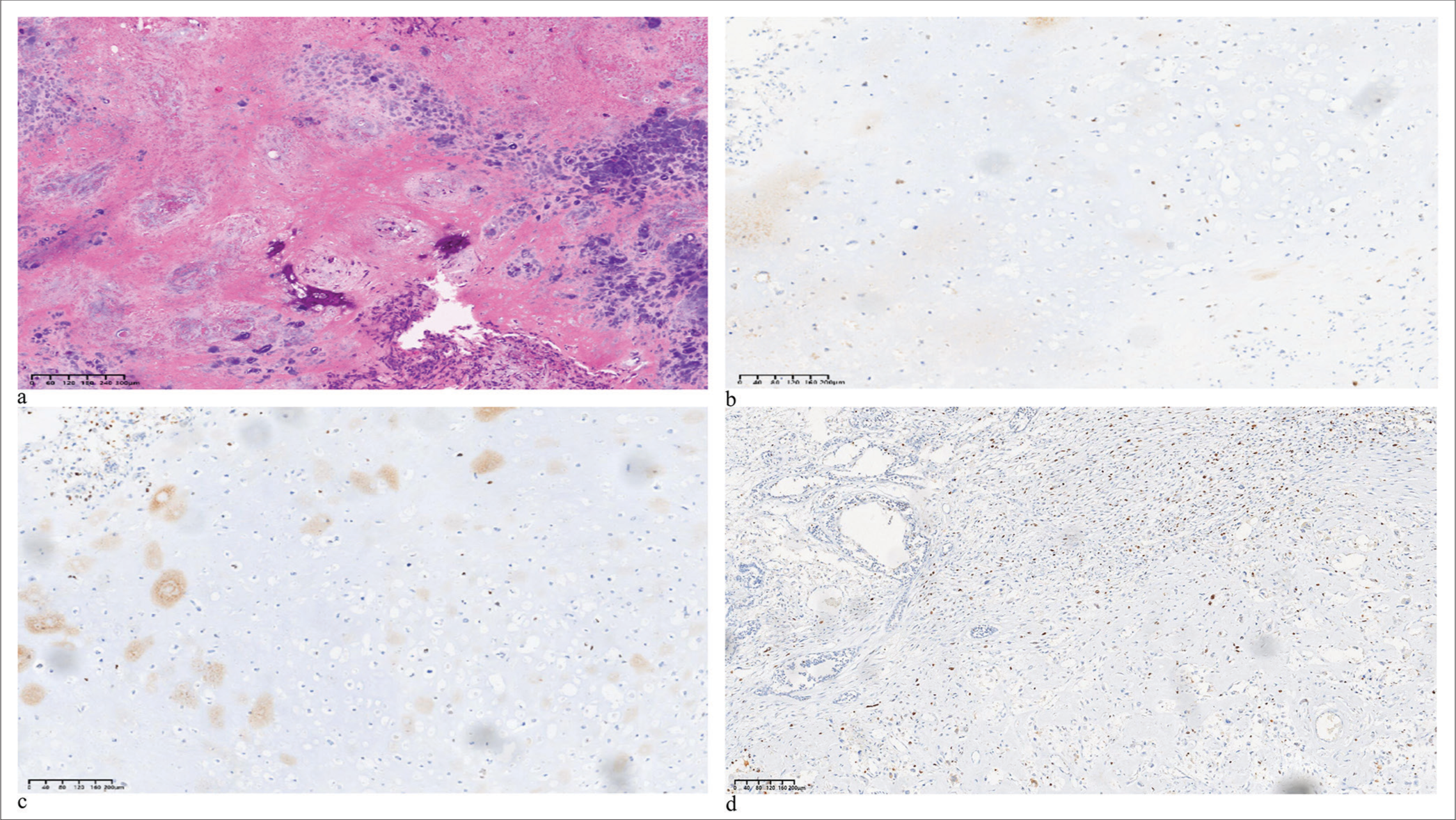 The (a) hematoxylin and eosin and (b-d) immunohistochemistry (IHC) images of the case patients (IHC markers are as follows: P63, EGFR, Ki-67). (HE: Hematoxylin and eosin, EGFR: Epidermal growth factor receptor)