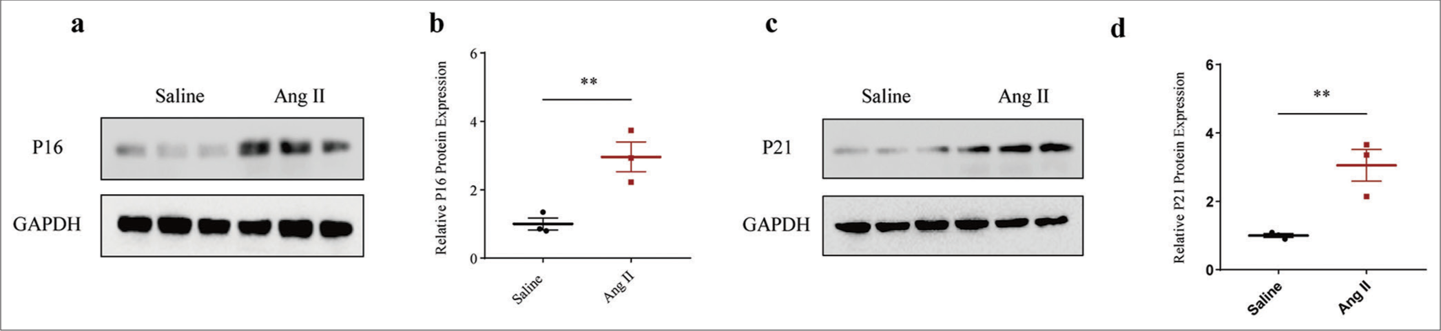 Higher senescence-related protein expression in Ang II-induced HASMCs. (a and b) Relative P16 protein expression in Ang II-induced modeled or saline-treated control HASMCs based on immunoblotting. (c and d) Relative P21 protein expression in Ang II-induced modeled or saline-treated HASMCs based on immunoblotting. All experimental data were derived from over three independent tests and expressed as mean ± standard deviation. (**P < 0.01. Ang II: Angiotensin II, HASMCs: Human aortic smooth muscle cells.)