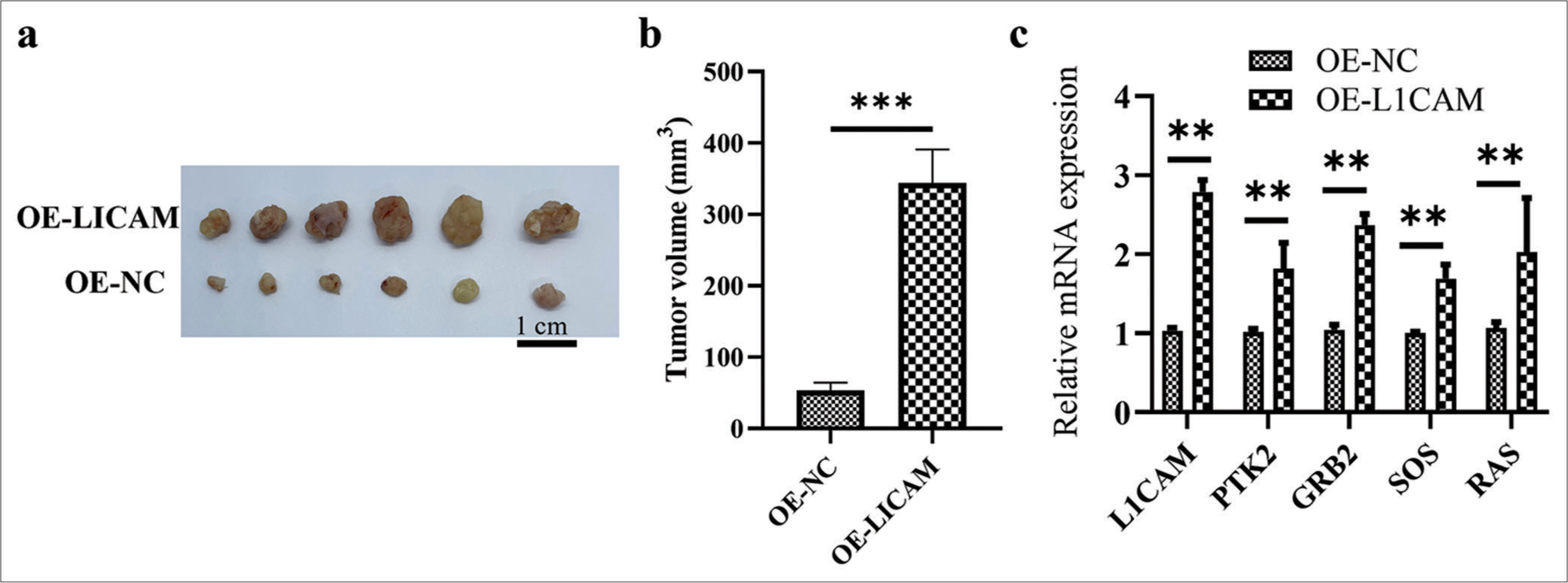 L1CAM promotes the progression of subcutaneous EC tumor. (a) Images and (b) quantification of tumor growth after transfected KLE EC cells were subcutaneously injected into mice (n = 6). (c) The L1CAM, PTK2, GRB2, SOS, and RAS mRNA levels obtained by RT-qPCR. **P < 0.01 indicates high statistical significance. (***P < 0.001 indicates very high statistical significance. L1CAM: L1 cell adhesion molecule, GRB2: Growth factor receptor-bound protein 2, SOS: Son of sevenless, RAS: Rat sarcoma, EC: Endometrial cancer, mRNA: Messenger RNA, RT-qPCR: Reverse transcription quantitative real-time polymerase chain reaction, NC: Negative control, OE: Overexpression, PTK: Protein tyrosine kinase.)