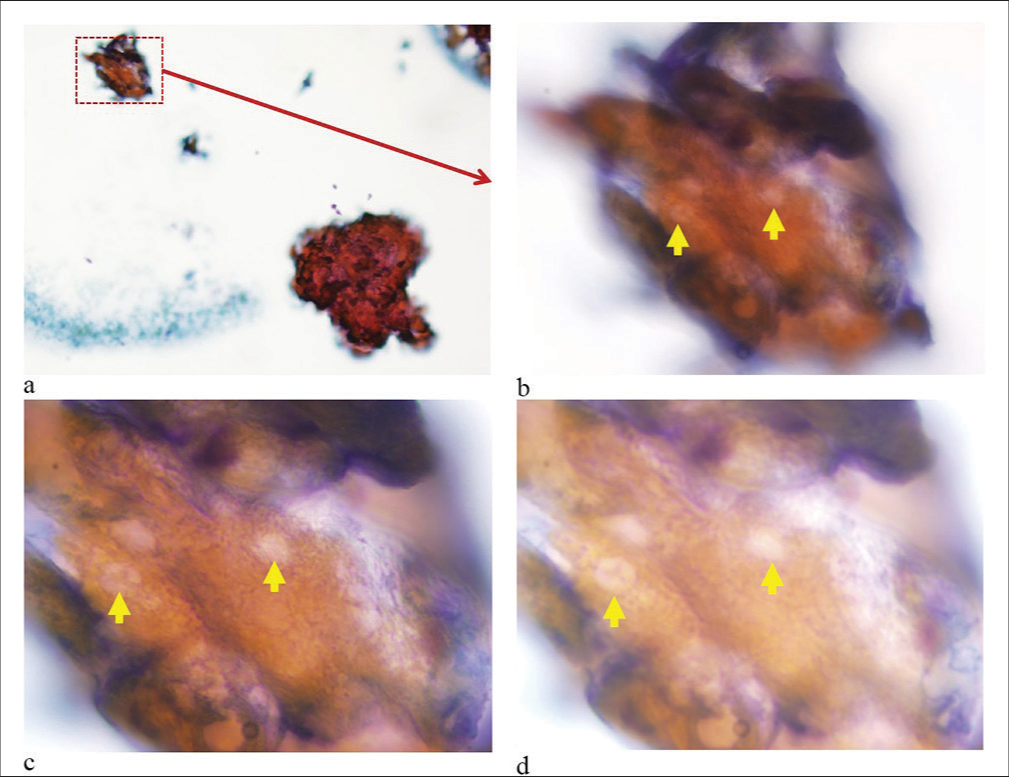 (a-d) Clumps of keratinized debris with some identifiable ghost cells (yellow arrows). The tightly cohesive groups of keratinized cells did not spread well as compared to other squamous epithelial lesions, making the details of individual cells as ghost cells in cytology smears difficult to appreciate and photograph. (Pap stained direct smear. a: ×10; b: ×60; c: ×100 Oil, Focus 1 to highlight the overall structure; d: ×100 Oil, Focus 2 to provide enhanced detail with increased light.