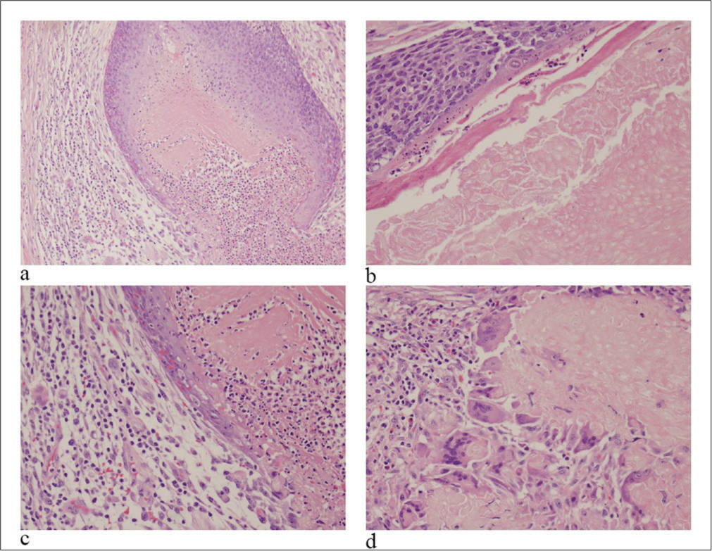 Hematoxylin and Eosin (HE) stained sections of resection (a: ×4; b-d: ×20 ). (a) Islands of basaloid cells at periphery with center showing shadow cells. (b) Basaloid cells with shadow cells. (c and d) Giant cells surrounding an area with keratinized ghost cells.