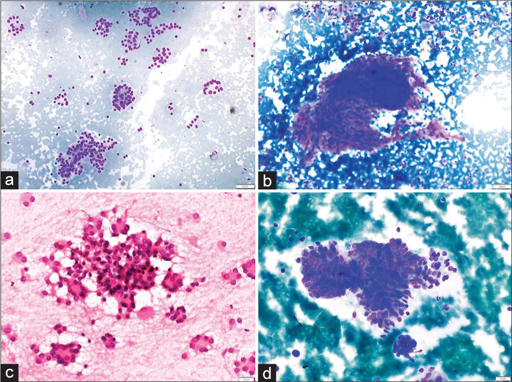 (a and b) Non-neoplastic. (a) Smear showing microfollicles in a case of adenomatous nodule (MGG, ×100). (b) Aspirate smear showing a pseudo papillary cluster of follicular epithelial cells in colloid goiter (MGG, ×100). (c and d) Neoplastic. (c) Plentiful microfollicles in follicular adenoma (H&E, ×400). (d) Cohesive cluster of cells in papillary thyroid carcinoma. The cluster is avascular and the peripheral cells are irregularly arranged giving rise to vague papillae like arrangement. (MGG, ×400). (MGG: May Grunwald Giemsa stain, H and E: Hematoxylin and Eosin).