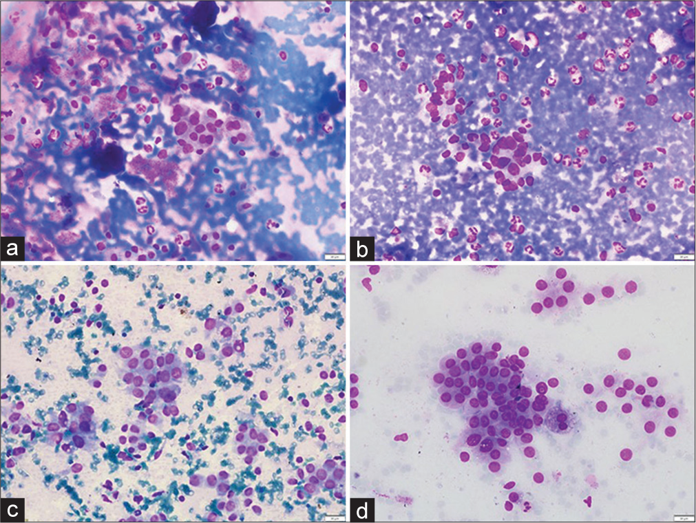 (a and b) Non-neoplastic. (a). Smear showing cluster and few scattered follicular epithelial cells with occasional intranuclear inclusion and an occasional nuclear groove in lymphocytic thyroiditis (MGG, ×400). (b) Aspirate smear showing follicular epithelial cells with mild pleomorphism (MGG, ×400). (c and d) Neoplastic. (c) Intranuclear inclusion in papillary thyroid carcinoma (MGG, ×400). (d) An occa sional sheet and few scattered follicular epithelial cells with mild pleomorphism in papillary thyroid carcinoma (MGG, ×400). (MGG: May Grunwald Giemsa stain, H and E: Hematoxylin and Eosin).