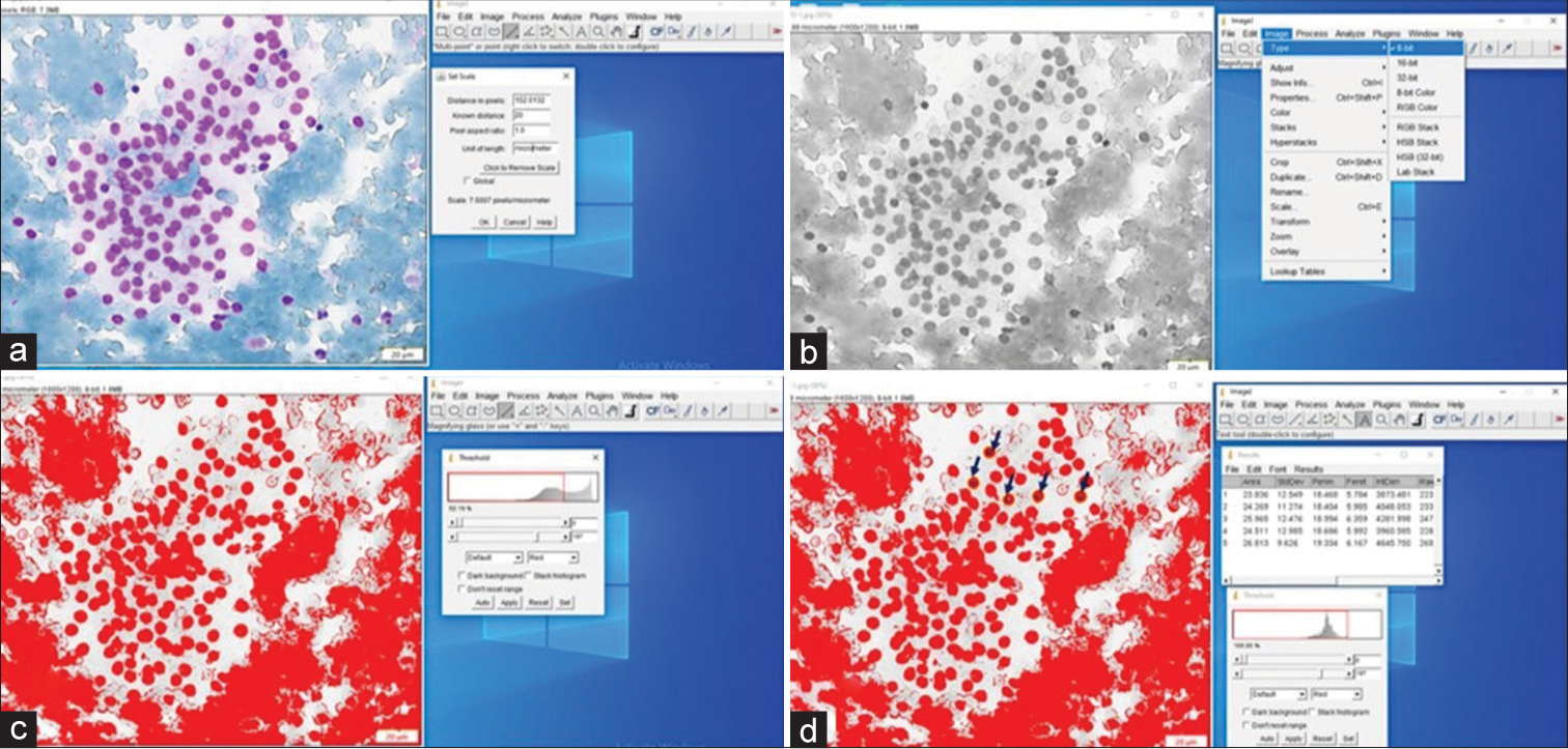 Image morphometry in atypia of undetermined significance lesion of thyroid with the outcome of follicular nodular disease (colloid goiter). (a) Captured image is displayed and the calibration is set up. (b) The colored image is converted into a 8-bit gray image. (c) The nuclei are detected by adjusting the gray threshold. (d) The individual nuclei are detected (arrows) and morphometric parameters are measured.