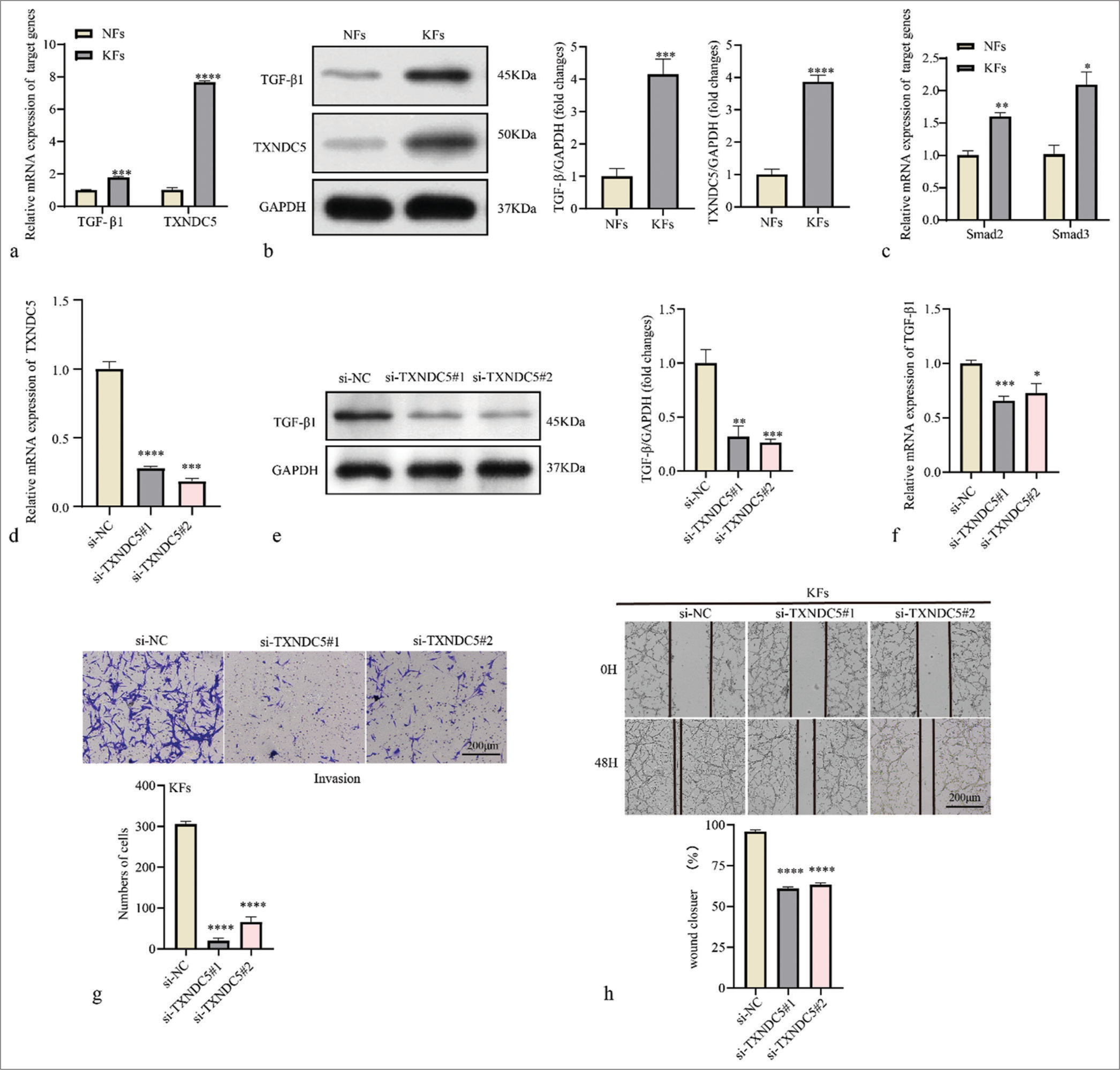 Thioredoxin domain-containing protein 5 (TXNDC5) is involved in migration and invasion of keloid fibroblasts (KFs). (a) Differential mRNA expression levels of transforming growth factor-beta 1 (TGF-β1) and TXNDC5 in normal fibroblasts (NFs) and KFs. (b) Differential protein expression levels of TGF-β1 and TXNDC5 in NFs and KFs. (c) Differential mRNA expression levels of Smad2 and Smad3 in NFs and KFs. (d) Reverse transcription-quantitative polymerase chain reaction was used to determine transfection efficiency of si-TXNDC5 in KFs. (e and f) The protein and messenger RNA level of TGF-β1 in KFs treated with si-TXNDC5. (g) Evaluation of fibroblast invasiveness using the Transwell invasion assay. (h) Assessment of fibroblast migration at 48 h in a wound healing assay. Where *P < 0.05, **P < 0.01,***P < 0.001, and ****P < 0.0001.