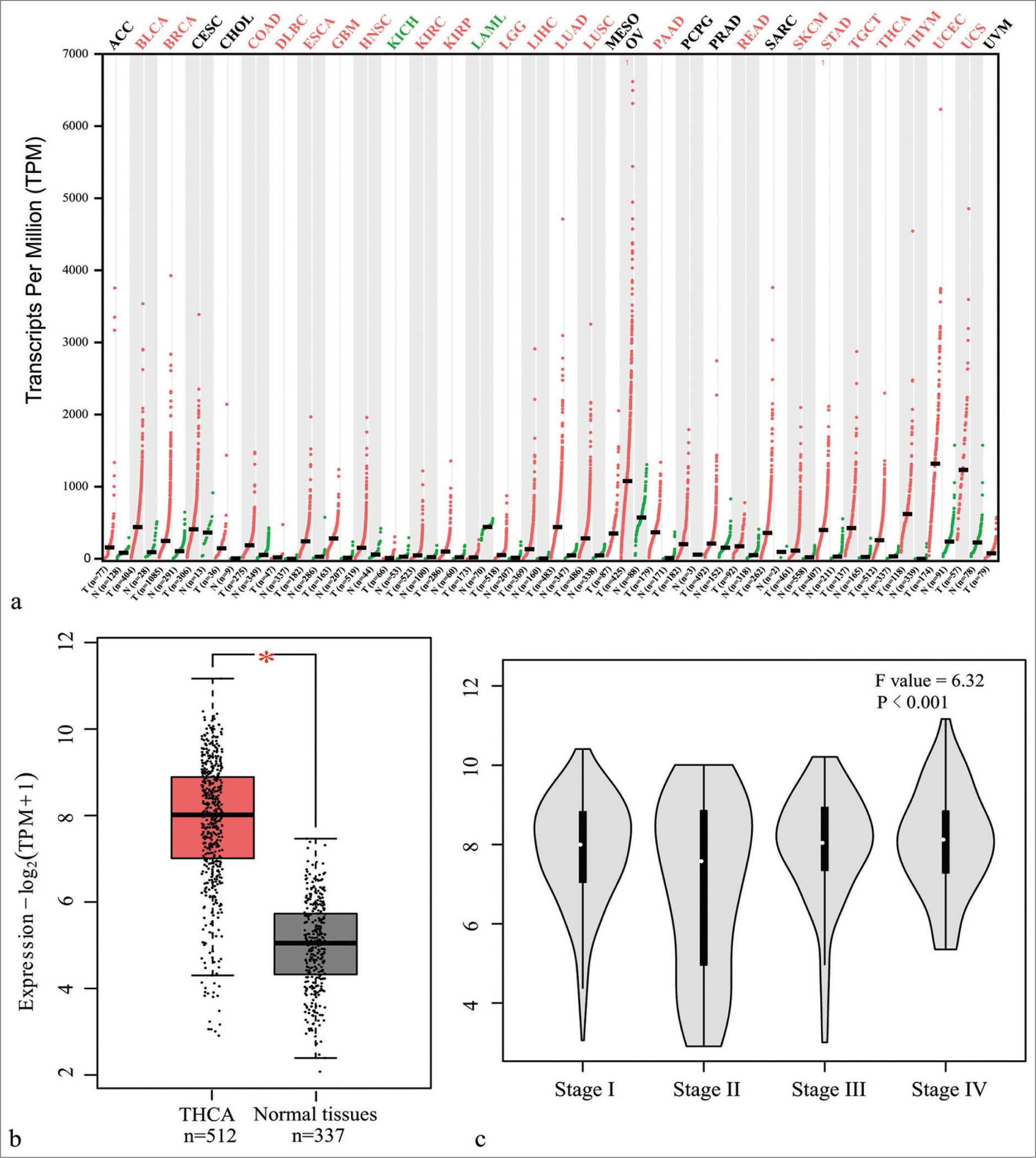 MDK gene level was evaluated using the GEPIA online database. (a) MDK gene expression profile in different cancer tissues; red and green indicate an increase and decrease, respectively, in MDK expression in tumors. (b) MDK gene expression in thyroid carcinoma tissues and normal tissues; (c) MDK gene level at different TC stages (*P < 0.05). (MDK: Midkine, GEPIA: Gene expression profiling interactive analysis, THCA: Thyroid carcinoma, n: Number, TPM: Transcripts per million, TC: Thyroid cancer. ACC: Adrenocortical carcinoma; BLCA: Bladder Urothelial Carcinoma; BRCA: Breast invasive carcinoma; CESC: Cervical squamous cell carcinoma and endocervical adenocarcinoma; CHOL: Cholangio carcinoma; COAD: Colon adenocarcinoma; DLBC: Lymphoid Neoplasm Diffuse Large B-cell Lymphoma; ESCA: Esophageal carcinoma; GBM: Glioblastoma multiforme; HNSC: Head and Neck squamous cell carcinoma; KICH: Kidney Chromophobe; KIRC: Kidney renal clear cell carcinoma; KIRP: Kidney renal papillary cell carcinoma; LAML: Acute Myeloid Leukemia; LGG: Brain Lower Grade Glioma; LIHC: Liver hepatocellular carcinoma; LUAD: Lung adenocarcinoma; LUSC: Lung squamous cell carcinoma; MESO: Mesothelioma; OV: Ovarian serous cystadenocarcinoma; PAAD: Pancreatic adenocarcinoma; PCPG: Pheochromocytoma and Paraganglioma; PRAD: Prostate adenocarcinoma; READ: Rectum adenocarcinoma; SARC: Sarcoma; SKCM: Skin Cutaneous Melanoma; STAD: Stomach adenocarcinoma; TGCT: Testicular Germ Cell Tumors; THCA: Thyroid carcinoma; THYM: Thymoma; UCEC: Uterine Corpus Endometrial Carcinoma; UCS: Uterine Carcinosarcoma; UVM: Uveal Melanoma).