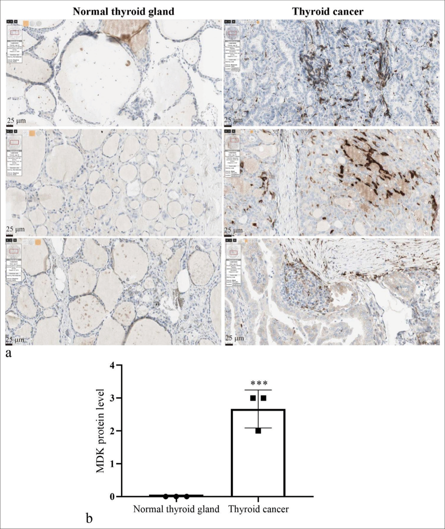 MDK expression was enhanced in TC tissues. (a) MDK protein levels were measured by immunohistochemistry staining in TC with normal thyroid gland tissues using the Human Protein Atlas database. (b) Histogram represents the MDK expression. *** P < 0.001, n = 3. (MDK: Midkine, TC: Thyroid cancer.).