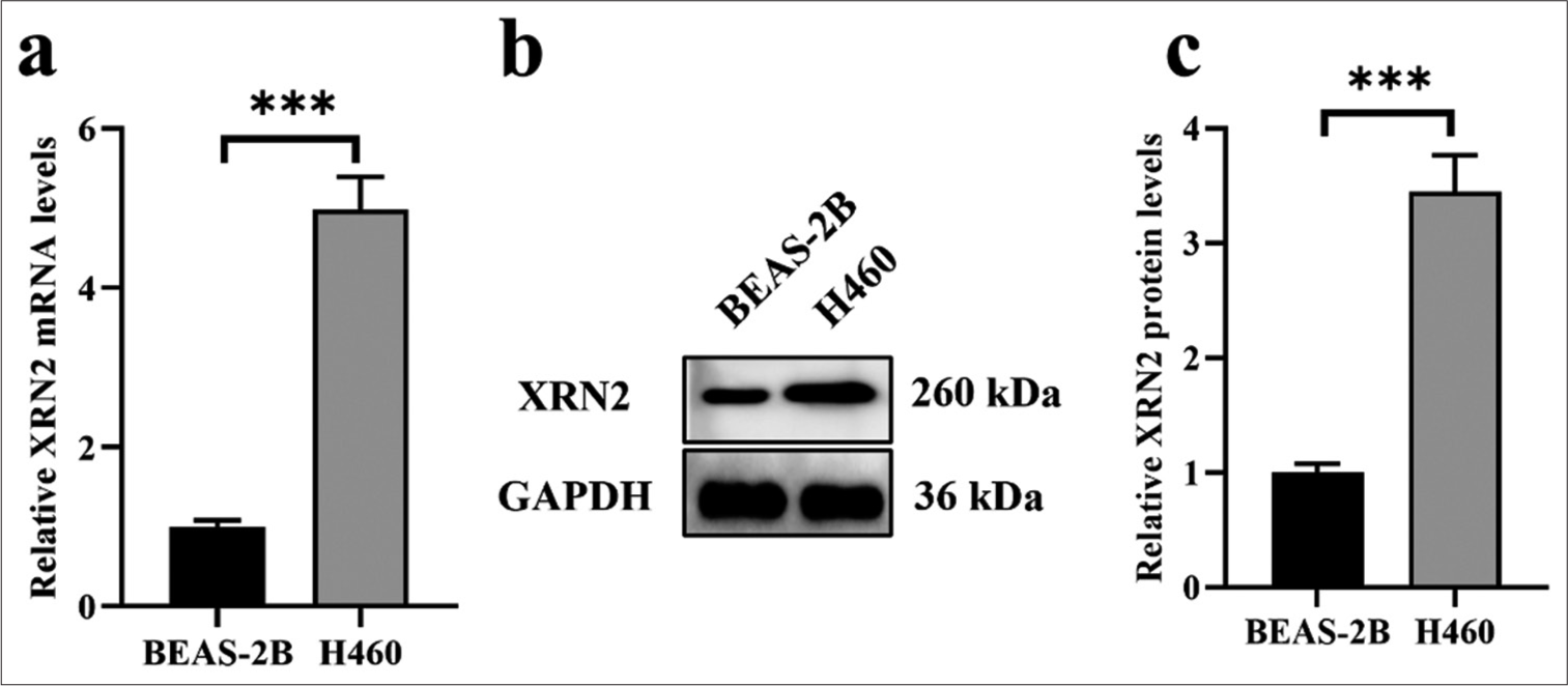 XRN2 was upregulated in NSCLC. (a) The messenger RNA levels of XRN2 in the H460 NSCLC cell line and BEAS-2B human bronchial epithelial cells. (b and c) Protein expression levels of XRN2 in H460 and BEAS-2B cells. n = 6. (***P < 0.001). (XRN2: 5’-3’ exoribonuclease 2, GAPDH: Glyceraldehyde-3-phosphate dehydrogenase, H460 cells: NSCLC cell line; BEAS-2B: Human bronchial epithelial cells, NSCLC: Non-small-cell lung cancer.)