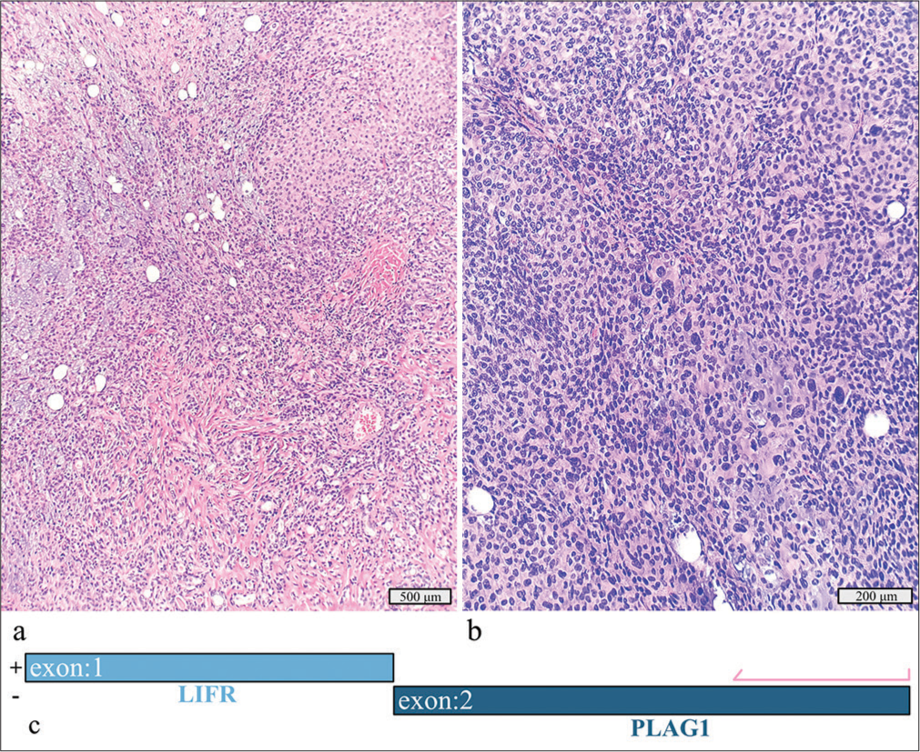 Myoepithelial carcinoma ex pleomorphic adenoma with a detected LIFR::PLAG1 fusion. (a) Hematoxylin and eosin stain, ×10 objective. (b) Hematoxylin and eosin stain, ×20 objective. (c) Schematic view of the detected LIFR::PLAG1 fusion demonstrating anchored primer regions spanning exon 2 of PLAG1 and exon 1 of LIFR. The “+” denotes the gene-specific anchored primer (first strand) and () the universal primer (second strand). The arrow represents the gene-specific primer.