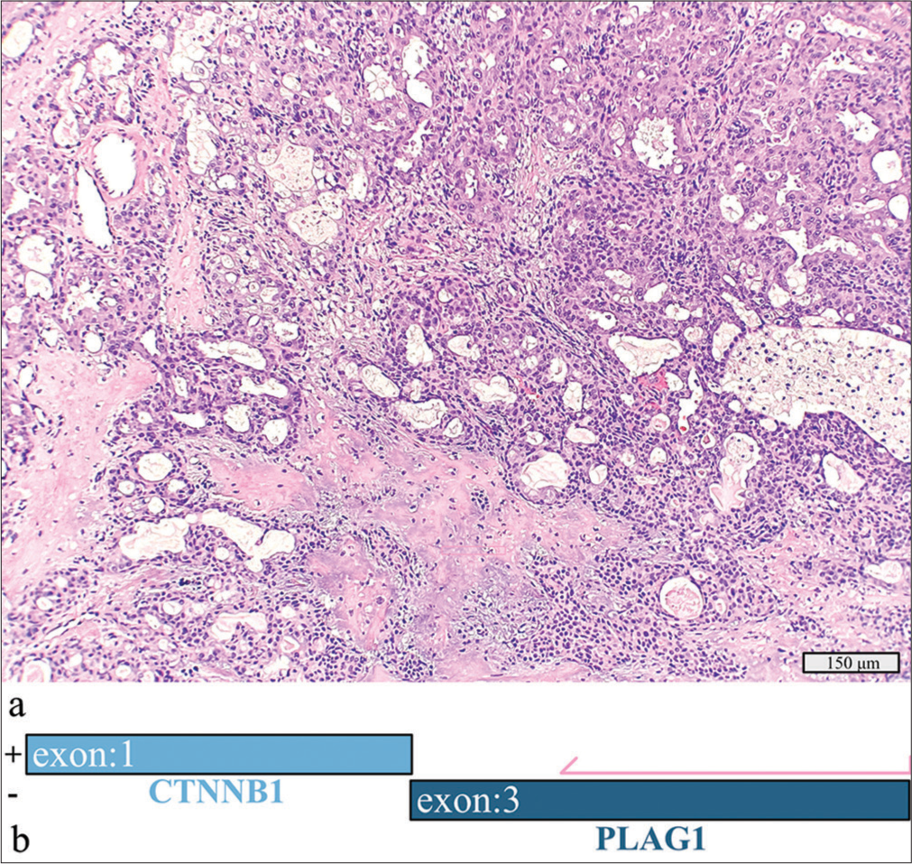 Mucoepidermoid carcinoma, well-differentiated ex-pleomorphic adenoma with a detected CTNNB1::PLAG1 fusion. (a) Hematoxylin and eosin stain, 20× objective. (b) Schematic view of the CTNNB1::PLAG1 fusion demonstrating anchored primer regions spanning exon 3 of PLAG1 and exon 1 of CTNNB1. The “+” denotes the gene-specific anchored primer (first strand) and (-) the universal primer (second strand). The arrow represents the gene-specific primer.