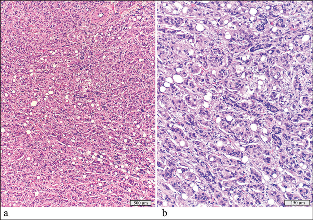 Salivary duct carcinoma with a detected BRAF p.V600E mutation. (a) Hematoxylin and eosin stain, ×10 objective. (b) Hematoxylin and eosin stain, ×40 objective.