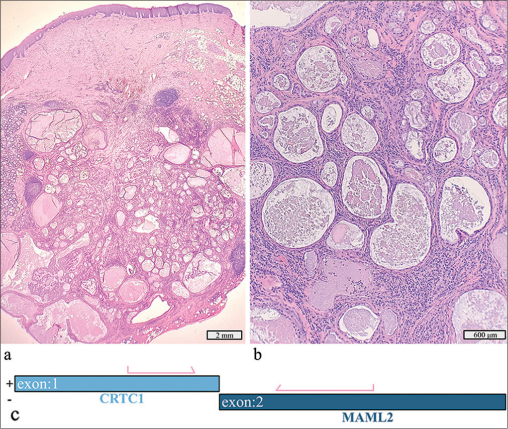 Low-grade mucoepidermoid carcinoma with a detected CRTC1::MAML2 fusion. (a) Hematoxylin and eosin stain, ×4 objective. (b) Hematoxylin and eosin stain, ×10 objective. (c) Schematic view of the detected CRTC1::MAML2 fusion demonstrating anchored primer regions spanning exon 1 of CRTC1 and exon 2 of MAML1. The “+” denotes the gene-specific anchored primer (first strand) and (–) the universal primer (second strand). The arrows represent the gene-specific primer.