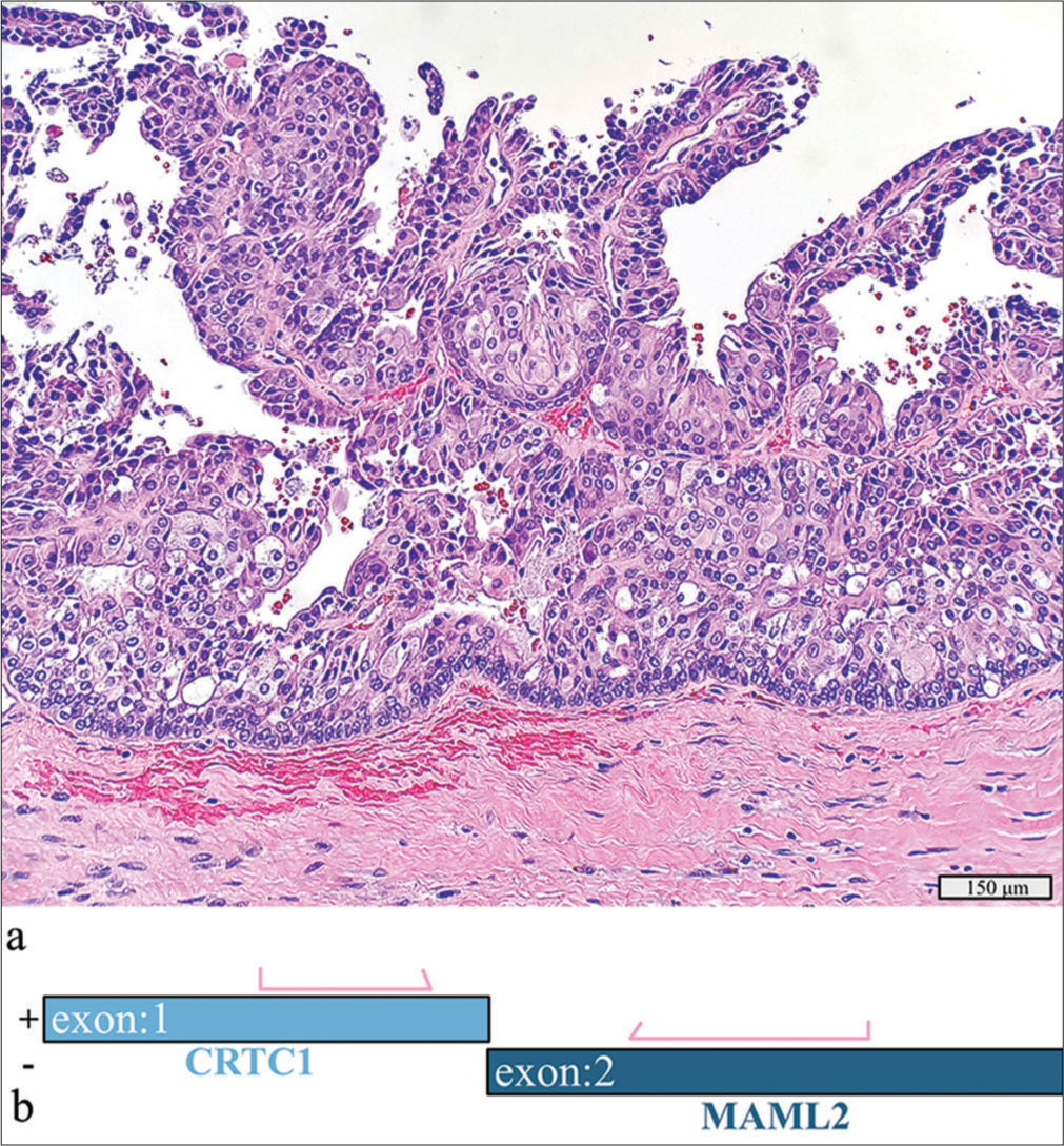 Intermediate-grade mucoepidermoid carcinoma with a detected CRTC1::MAML2 fusion. (a) Hematoxylin and eosin stain, ×20 objective. (b) Schematic view of the detected CRTC1::MAML2 fusion demonstrating anchored primer regions spanning exon 1 of CRTC1 and exon 2 of MAML2. The “+” denotes the gene-specific anchored primer (first strand) and (–) the universal primer (second strand). The arrows represent the gene-specific primer.