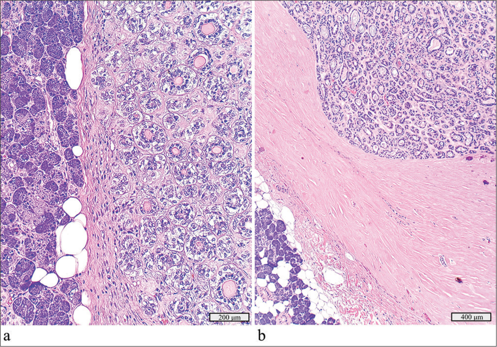 Adenoid cystic carcinoma ex pleomorphic adenoma with a detected HRAS p.Q61L mutation. (a) Focus of the adenoma component juxtaposed with benign salivary gland, hematoxylin and eosin stain, ×20 objective. (b) Focus of the adenoid cystic carcinoma component, hematoxylin and eosin stain, ×10 objective.