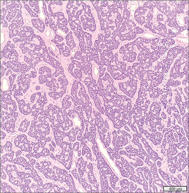 Basal cell adenoma with a detected CTNNB1 p.I35T mutation, hematoxylin and eosin stain, ×10 objective.