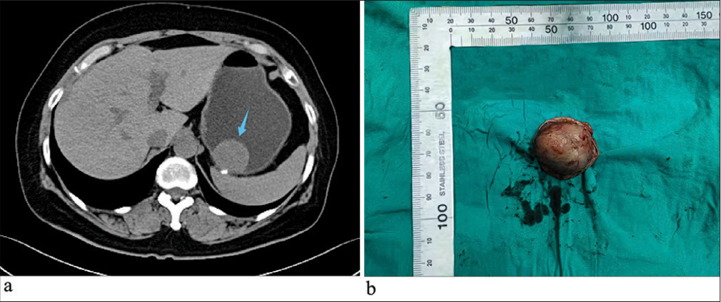 (a) Abdominal computed tomography with contrast enhancement showed a mass near the cardia on the lesser curvature side of the gastric body (blue arrow). (b) The tumor was nodular and measured 3 × 2.3 × 1.7 cm.