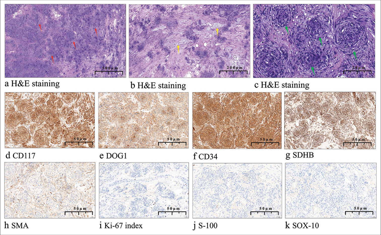 (a) Histopathologically, the tumor was composed of nodules of different size in a stromal background (red arrow, ×10). (b) Tumor cells were distributed at an uneven density and the stroma was hyalinized with mucinous degeneration (yellow arrow, ×15). (c) Tumor cells were spindle arranged in a perineurium-like pattern (green arrow, ×30). (d-h)Tumor tissue was immunohistochemically positive (×20) for cluster of differentiation 117, discovered on gastrointestinal stromal tumor-1, cluster of differentiation 34, succinate dehydrogenase iron-sulfur subunit B, and smooth muscle actin. (i)The Ki-67 antigen index was ≤1%. (j-k)Staining for S-100 calcium-binding protein and SRY-box 10 protein was negative. (H&E: Hematoxylin and eosin, CD117: Cluster of differentiation 117, DOG1: Discovered on gastrointestinal stromal tumor-1, CD34: Cluster of differentiation 34, SDHB: Succinate dehydrogenase iron-sulfur subunit B, SMA: Smooth muscle actin, Ki-67 index: Ki-67 antigen index, S-100: S-100 calcium-binding protein, SOX-10: SRY-box 10 protein).