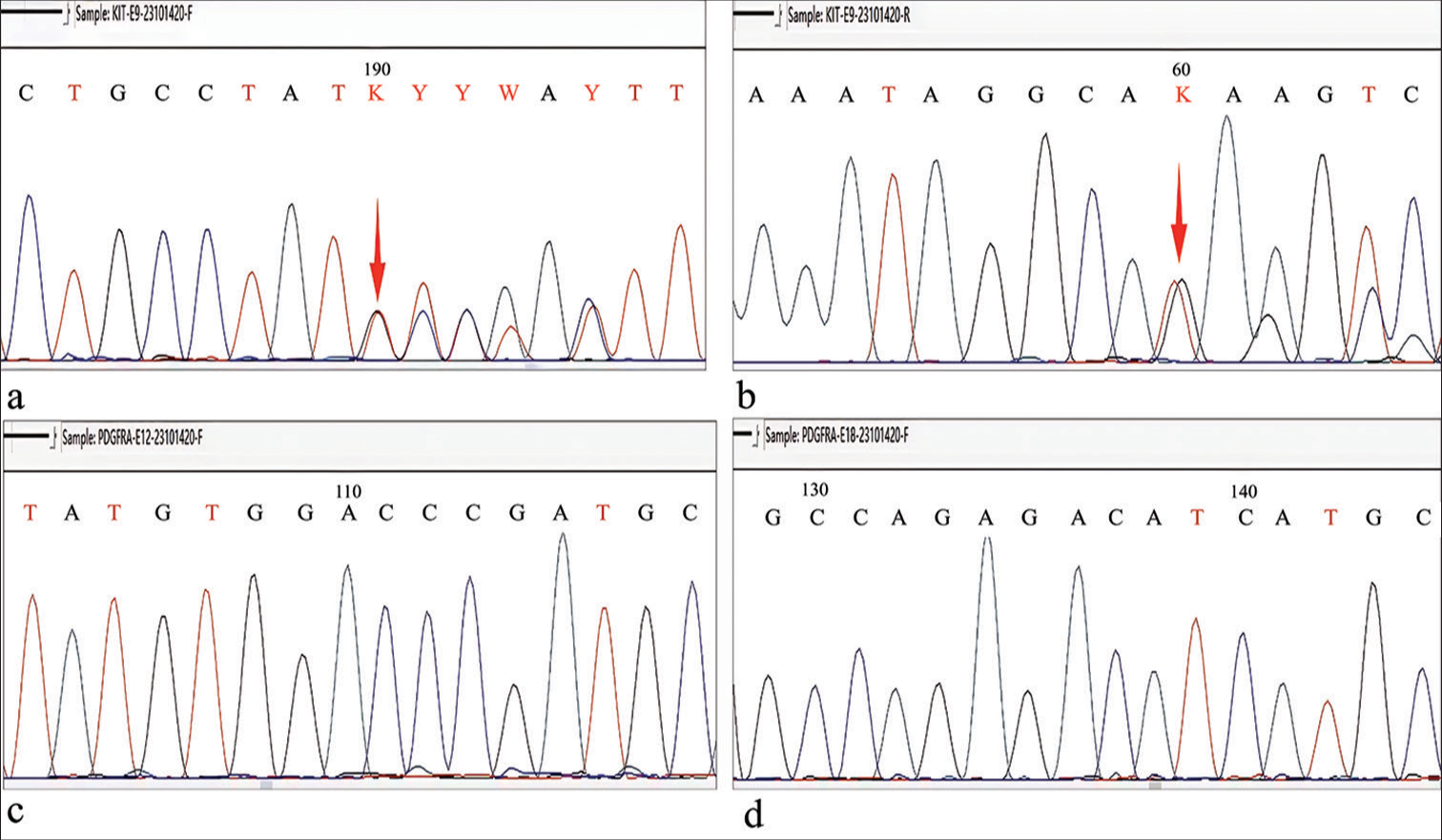 (a-b) Forward and reverse Sanger sequencing demonstrated c.1504_1509 (p.A502_Y503) duplication in exon 9 of Kinase Insert Domain Receptor (red arrow). (c-d)Forward sequencing of exon 12 and exon 18 of platelet-derived growth factor receptor alpha showed no mutation. (A: Adenine, C: Cytosine, T: Thymine, G: Guanine, K: G or T (keto bases), Y: C or T (pyrimidine bases).