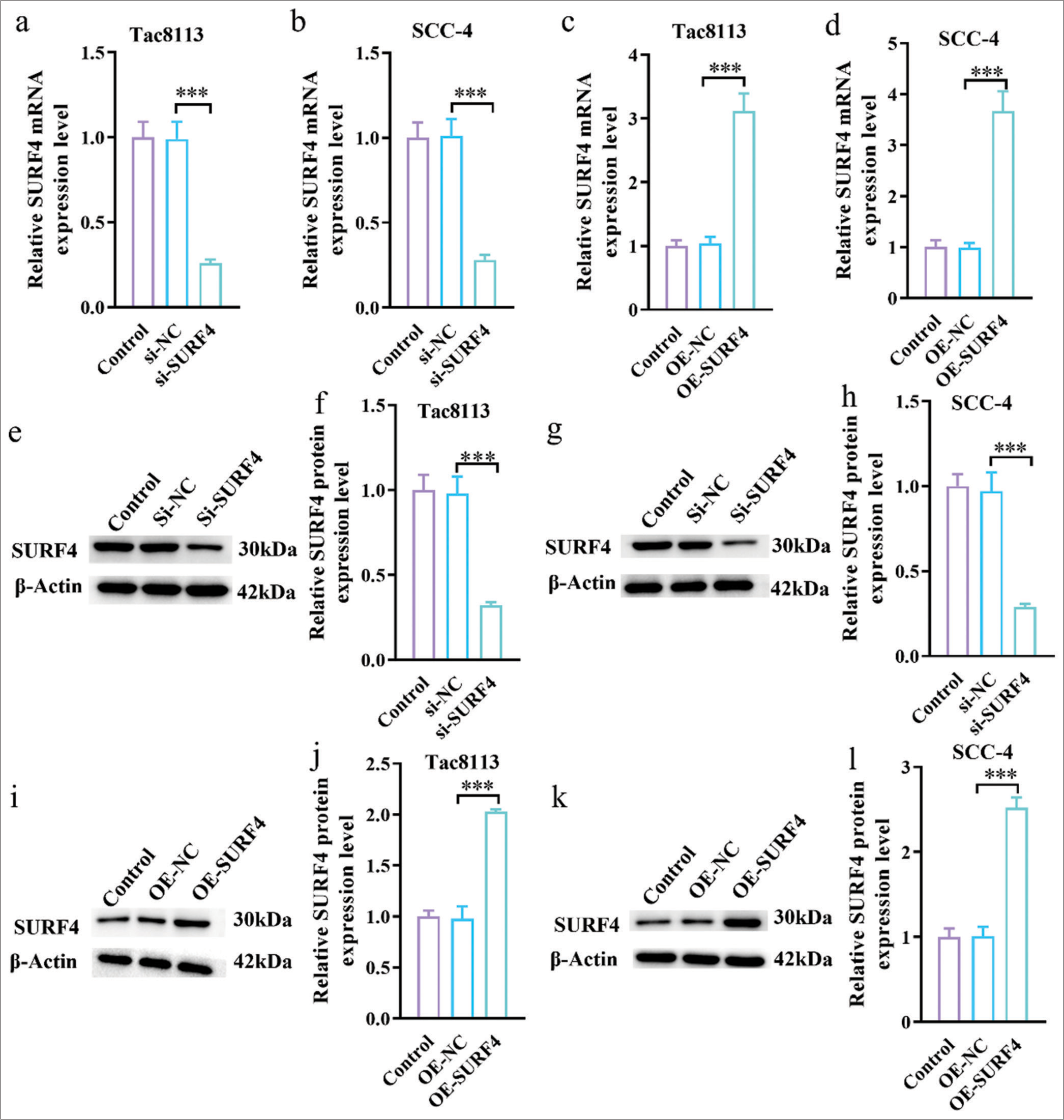 SURF4 overexpression plasmid and siRNA (SURF4) were successfully transfected into OSCC cells. (a and b) siRNA (SURF4) reduced the mRNA levels of SURF4 in Tac8113 and SCC-4 cells. (c and d) The SURF4 overexpression plasmid increased the mRNA levels of SURF4 in Tac8113 and SCC-4 cells. (e-h) The expression of SURF4 in Tca8113 and SCC-4 cells after silencing SURF4 was analyzed by Western blot analysis. (i-l) The expression of SURF4 in Tca8113 and SCC-4 cells after overexpressing SURF4 was analyzed by Western blot analysis (n = 6) (***P < 0.001). (SURF4: Surfeit 4, OSCC: Oral squamous cell carcinoma, siRNA (SURF4): si-SURF4, OE-SURF4: Overexpression SURF4, OSCC cell lines: Tac8113, SCC-4: Squamous cell carcinoma-4, siRNA: Small interfering RNA, mRNA: Messenger RNA.)