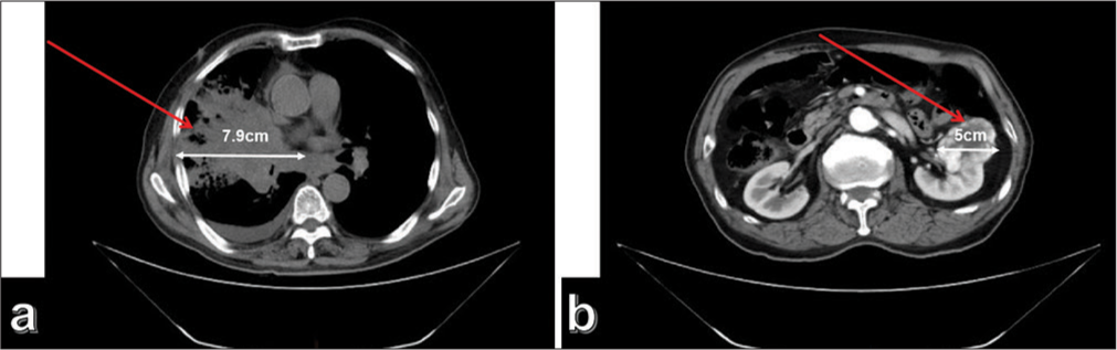 (a) Computed tomography (CT) shows a space-occupying lesion measuring approximately 7.9 cm × 5.4 cm in the right upper lobe of the lung near the hilar region (The red arrow indicates the location of the tumor); (b) CT showed a space-occupying lesion measuring approximately 5 cm × 4.6 cm in the left kidney. The arrows in the image indicate the location and extent of the tumor (The red arrow indicates the location of the tumor).