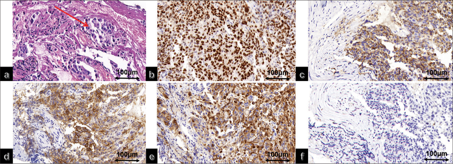 (a) High magnification of lung adenocarcinoma hematoxylin and eosin (The red arrow indicates tumor cells); immunohistochemical staining of lung adenocarcinoma showed positive (b) thyroid transcription factor-1, (c) Napsin A, (d) carbonic anhydrase IX, (e) cluster of differentiation 10, (f) and negative Paired box gene 8 (PAX-8).